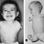 8. Thalidomide babies