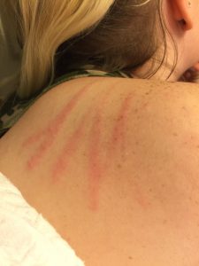 2. Scratches on the shoulder of one of my investigators which appeared after a particularly aggressive Spirit Box session. 